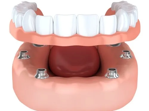 Over Denture