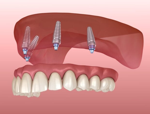 all on 4 dental implants near me