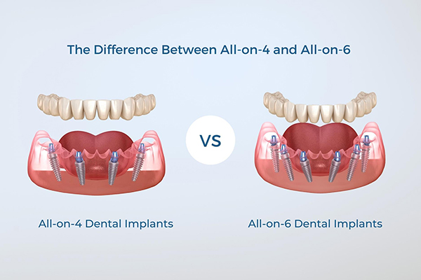All-on-4 vs All-on-6 Comparison