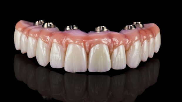 all on 4 dental implants teeth