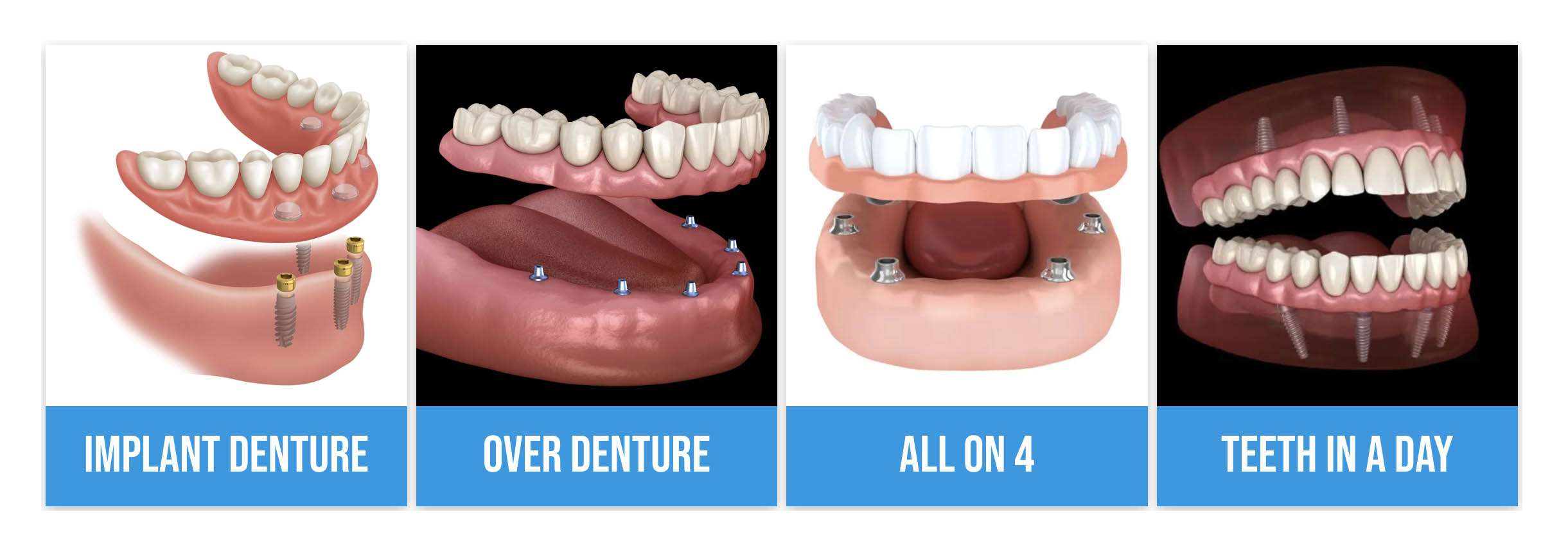denture implants comparison