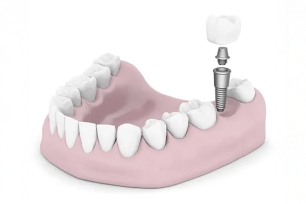 Implant Crowns Vs  Traditional Crowns: Key Differences Explained