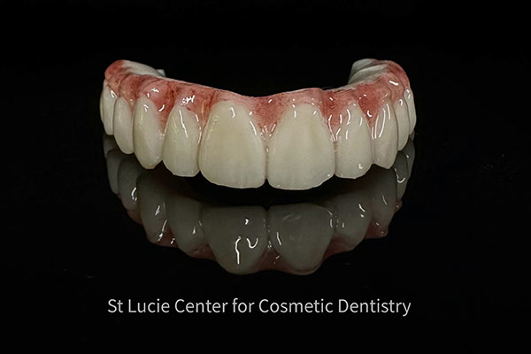 Dental Implants In Port St  Lucie, Florida – New Teeth In A Day