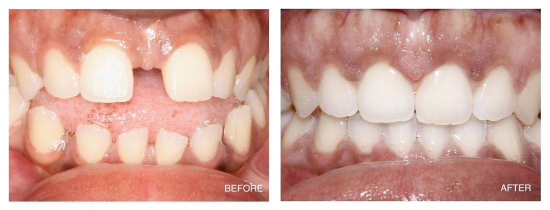 orthodontics in port st. Lucie before and after