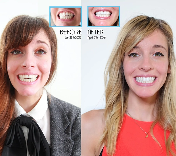 invisalign-consultation-header.webp