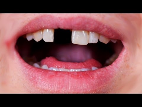 knocked out my tooth