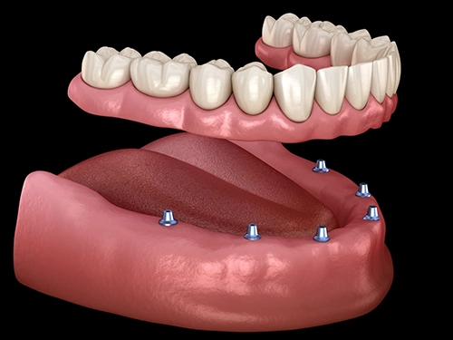 Over Denture