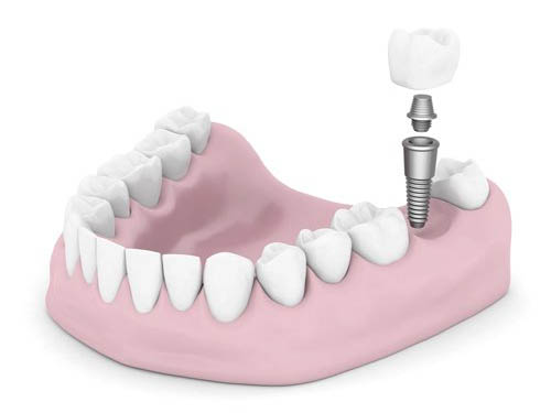 Single Implant
