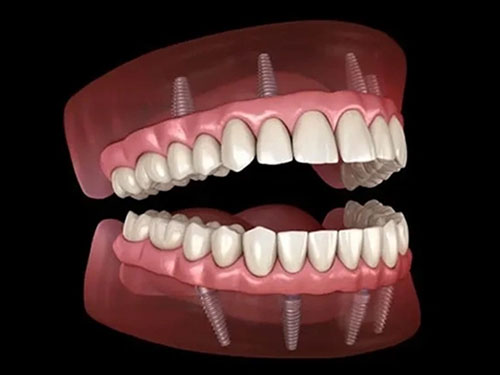 Dental implant surgical procedure