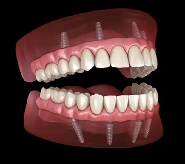 All-on-4 Dental Implants Transformation