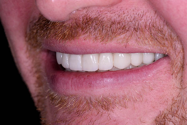 The Real Cost Of Delaying Tooth Replacement