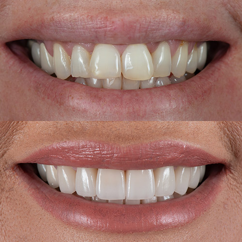 How Safe And Effective Is Professional Teeth Whitening?