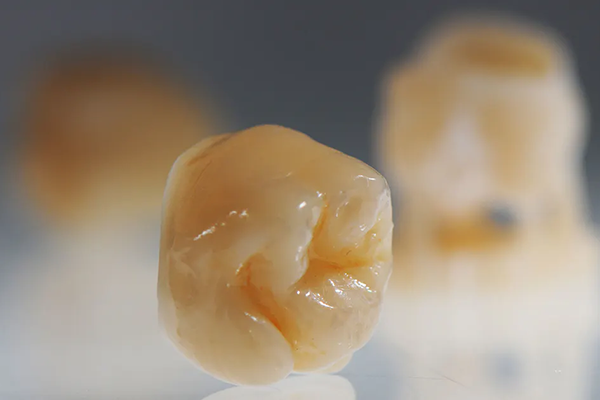 What Is The Best Tooth Replacement Option For Common Dental Issues?