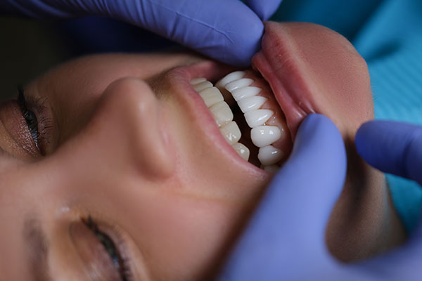 Veneers In Port St  Lucie, FL