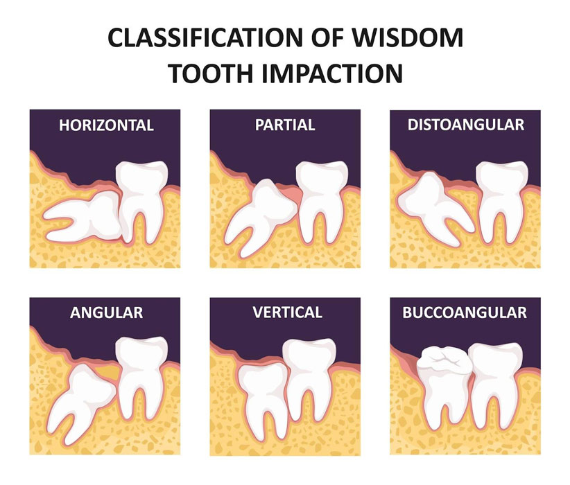 Classification of wisdom tooth impaction