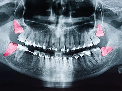wisdom-teeth-removal