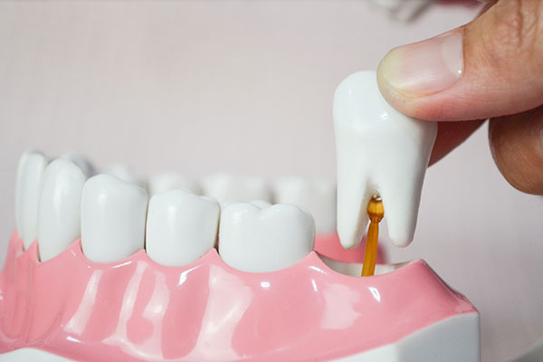 Wisdom Teeth Removal In Port St  Lucie, FL